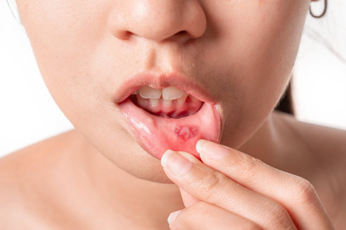 The Ultimate Guide to Healing Mouth Ulcers Fast and Naturally - Enzim Singapore