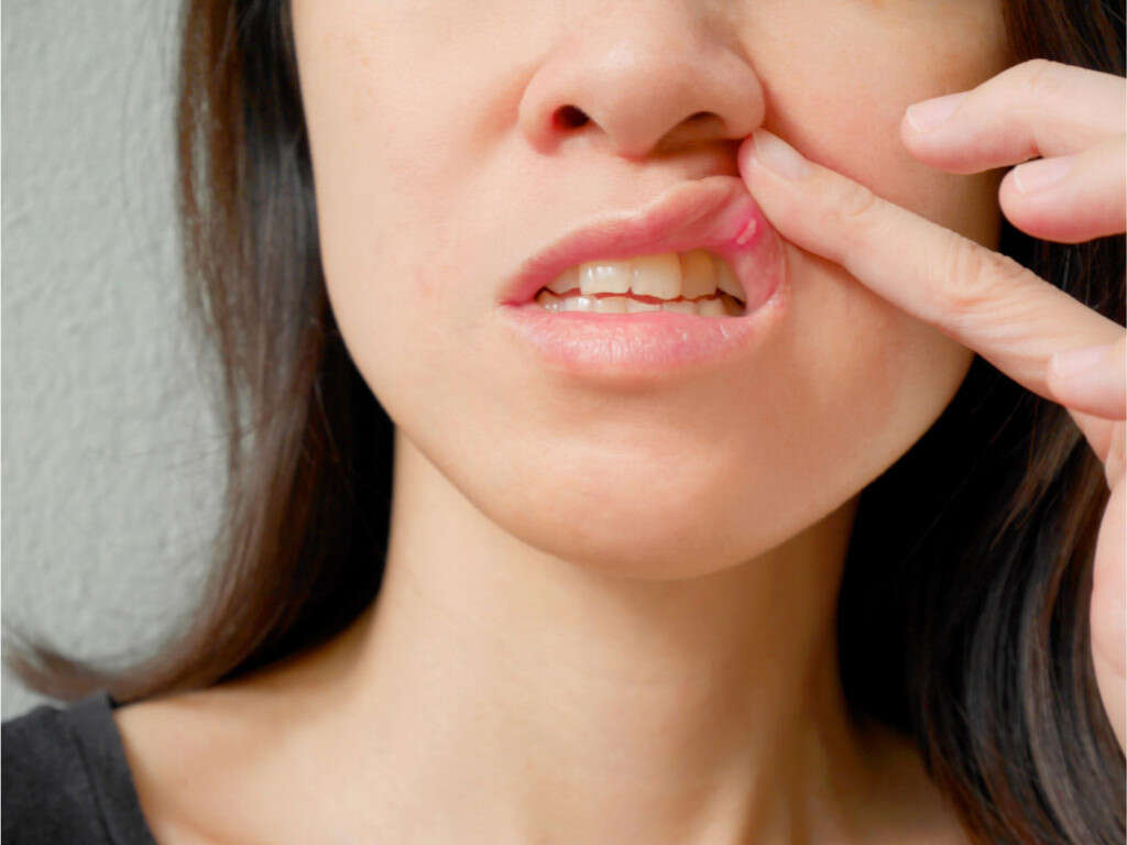 Why Aren't Your Mouth Ulcers Healing? - Enzim Singapore